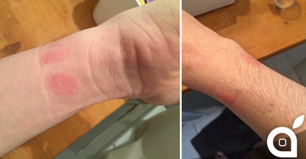 Hautreizung, allergische Reaktionen einiger Apple Watch-Benutzer