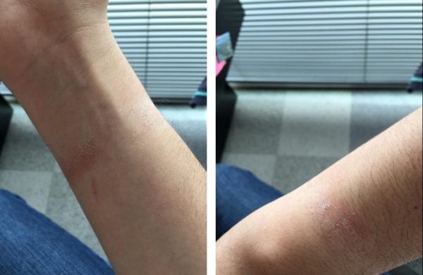 Hautreizung, allergische Reaktionen einiger Apple Watch-Benutzer